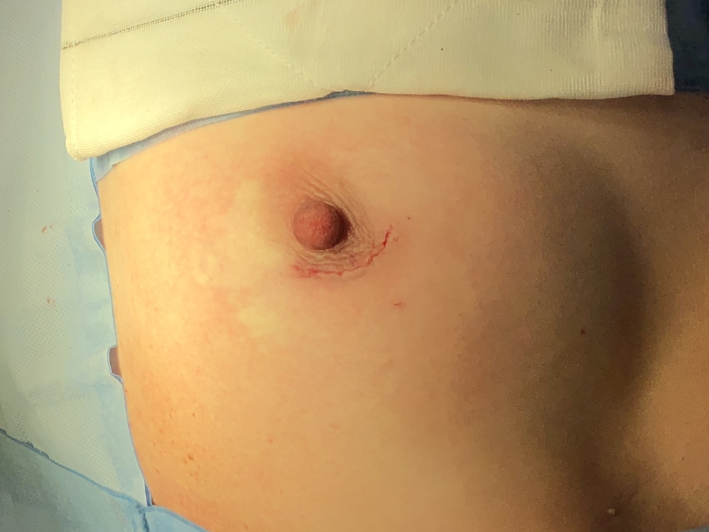 AFTER - BREAST CONSERVATION SURGERY